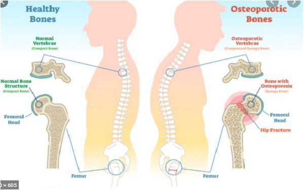 Durerile osoase şi articulare, Articulațiile osteoporozei doare